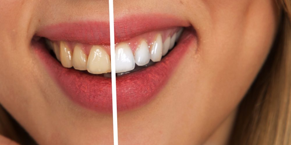 Teeth Whitening